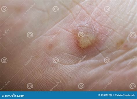 Dyshidrotic Eczema On The Foot Blister Dermatitis Stock Photo Image