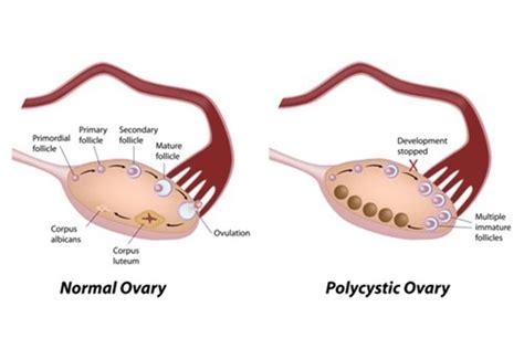 Do Polycystic Ovaries Equal Pcos Nabta Health