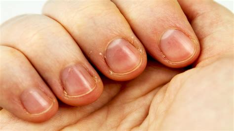 What Causes Keratin Build Up On Nails Nail Ftempo