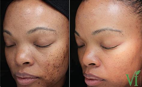 Vi Peel Before And After Darst Dermatology Charlotte Dermatologist