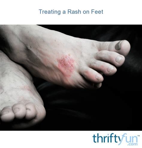 Treating A Rash On Feet Thriftyfun