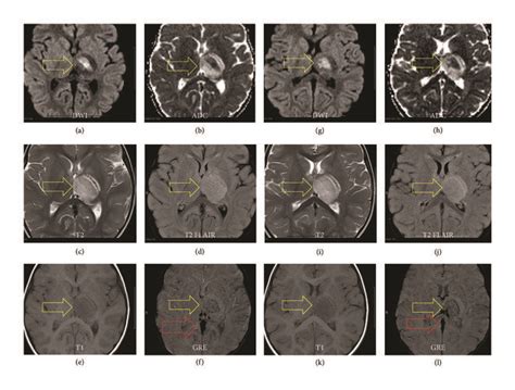 Mri Obtained To Confirm Deep Cerebral Venous Thrombosis And Left