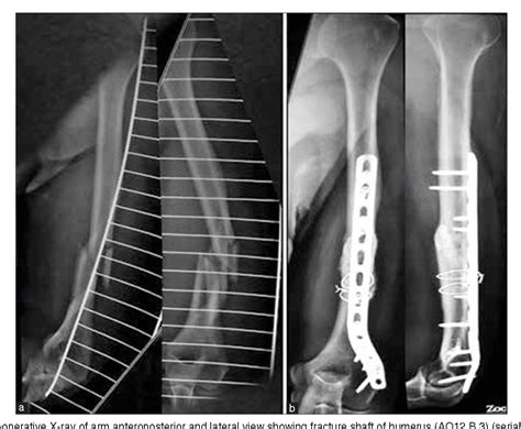Figure From Outcome Of Anatomic Locking Plate In Extraarticular Distal Humeral Shaft Fractures