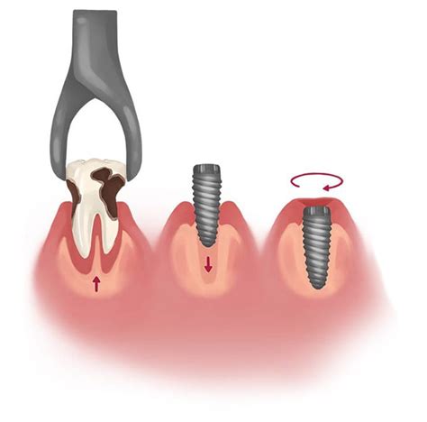 Understanding Immediate Dental Implants Same Day Dental Implants