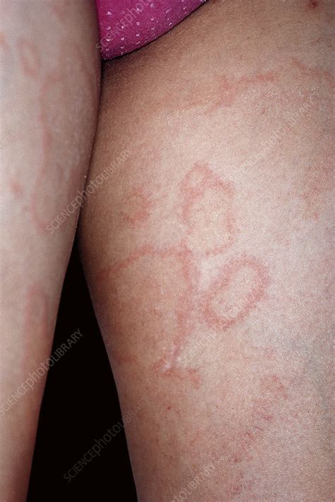 Hives Stock Image C0516643 Science Photo Library