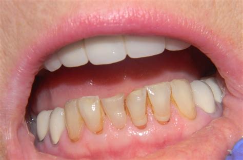 Dental Pearls: Cosmetic Dentistry- Teeth Bonding