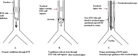 Anterior Tracheal Injury During Sternotomy Journal Of Cardiothoracic
