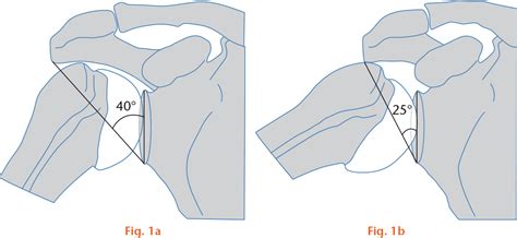 Effect Of Critical Shoulder Angle Glenoid Lateralization And Humeral