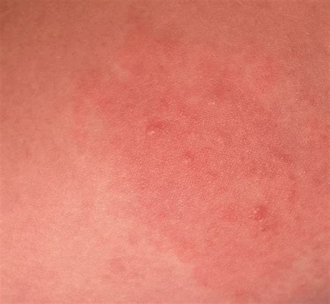 Dermdx Scattered Papules And Erythematous Rash Clinical Advisor