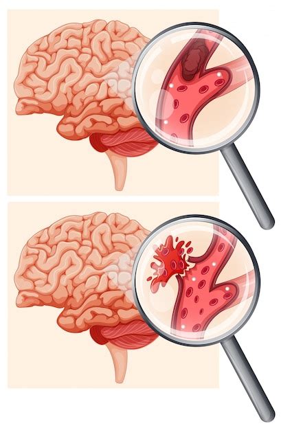 Cerebro humano y accidente cerebrovascular hemorrágico Vector Premium