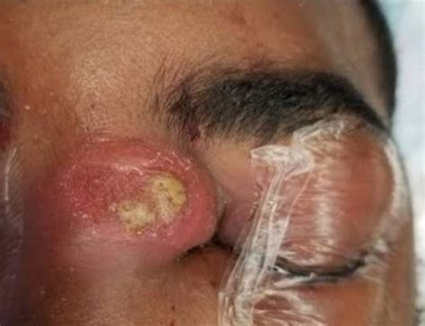 Bacterial Eye Infection Archives New Pimple Popping Videos