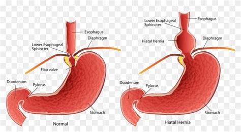 Mthfr And Digestion Healing The Hiatal Hernia Minor Hiatal Hernia Hd