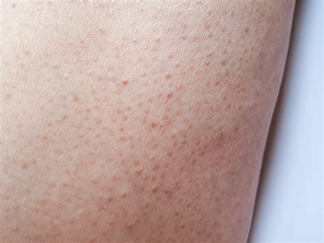 What Is Keratosis Pilaris And How To Get Rid Of It Ask The Skin Care E