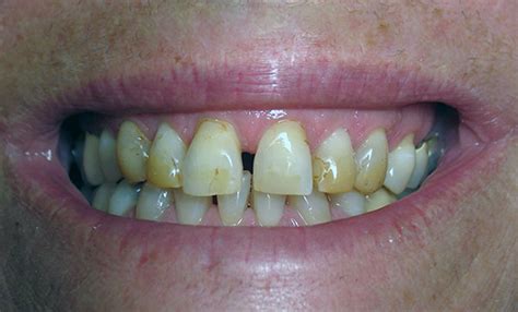 Your teeth have pores just like your skin. How to Remove Coffee Stains from Teeth? - Floss & Gloss ...