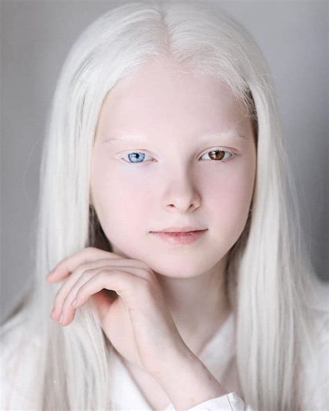 Stunning Portraits Of Year Old Girl With Albinism And Heterochromia