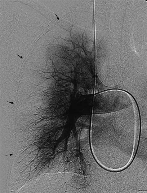 Image Shows Digital Subtraction Pulmonary Angiography Right Sided