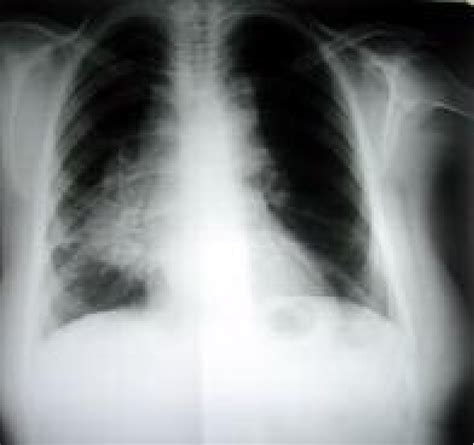 Chest X Ray Showing Multiple Mediastinal Lymph Nodes Download