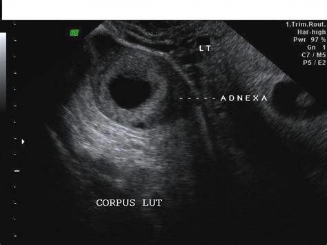 Wk 4 L 2 Corpus Luteal Cysts This Pt Had An Early Gestation Lt Adnx