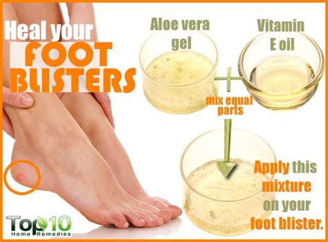 Home Remedies For Foot Blisters Top 10 Home Remedies