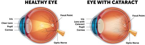 Cataract Is Caused By