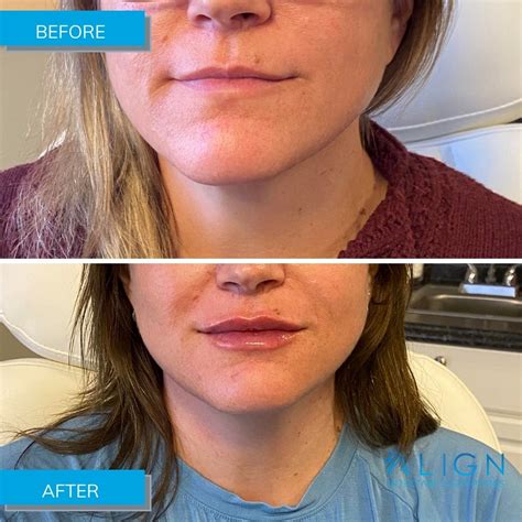 Before And After Lip Injections At Align Injectable Aesthetics