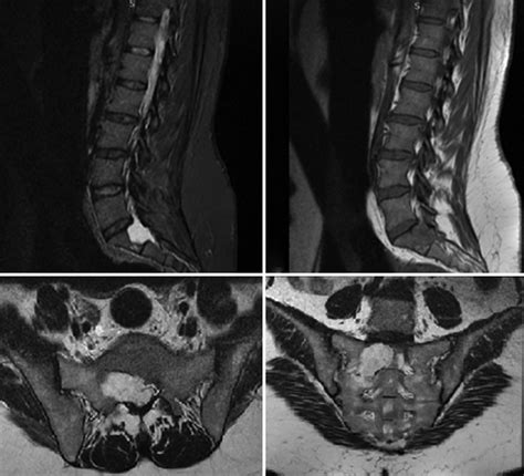 Magnetic Resonance Imaging Of The Lumbosacral Spine Sagittal