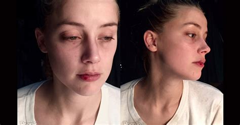 New Photos Of Amber Heard Show Bruised Eye And Bloody Lip Los Angeles