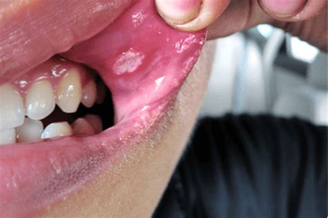 Canker Sores Apthous Stomatitis Causes Symptoms And Prevention Factdr