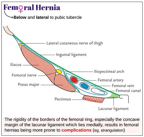 Femoral Hernia Borders