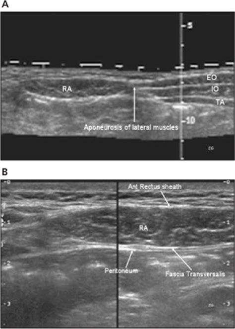 Sonography In Identification Of Abdominal Wall Lesions Presenting As