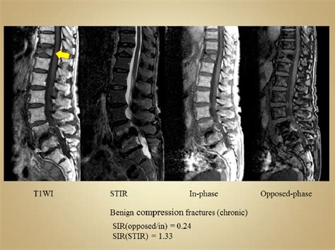 Figure From Differential Diagnosis Of Vertebral Compression Fracture