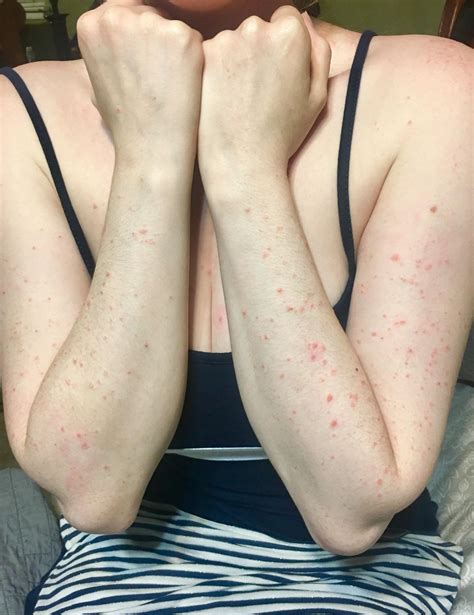 Please Help Identify This Rash It Shows Up On My Daughter When She