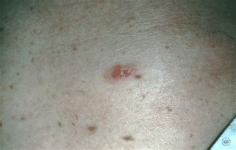 Melanoma What You Need To Know About Diagnosis And Treatment