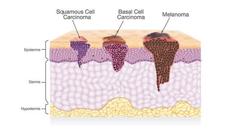 Other Skin Cancers Aim At Melanoma Foundation