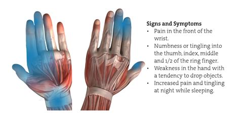 What is carpal tunnel syndrome? Carpal Tunnel Syndrome - Cable Crimping - Power and Cables