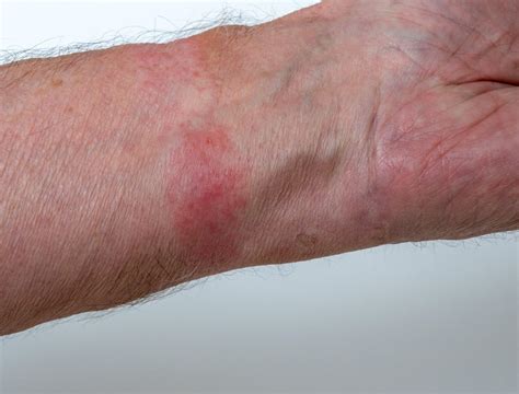 Dermatite Allergica Da Contatto Foto Cause E Cura Valori Normali