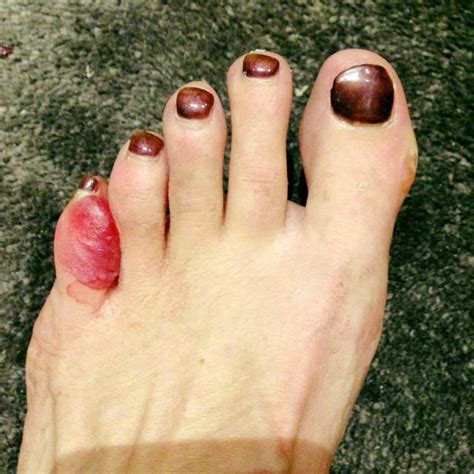 Blisters Between Toes 7 Expert Ways To Prevent