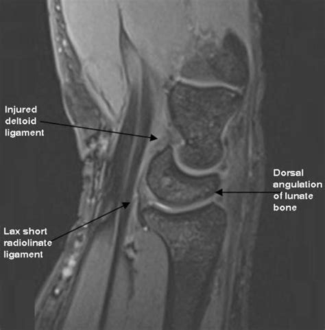 Sagittal Mri Image Ligamentous Injuries Leading To Dorsal Angulation Download Scientific