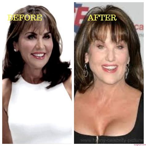 Singers Plastic Surgeries Photos Before After Page 2 Of 2 Surgery4
