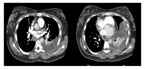 Ct Scan Of Chest With Contrast Showing Large Left Pleural Effusion With