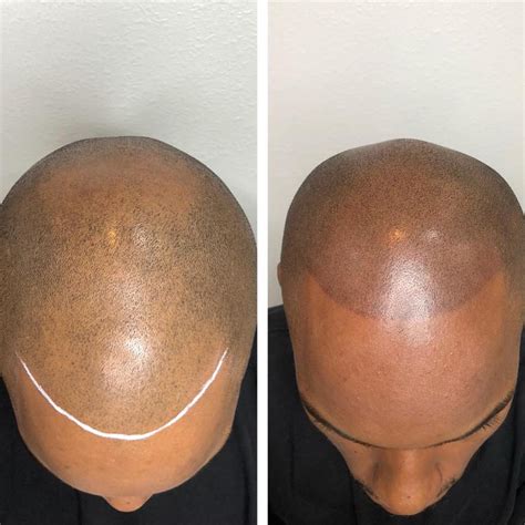 But if there is baldness on your mothers side there is a possibilty you might go. Scalp Micropigmentation Las Vegas | Hides Thinning Hair ...