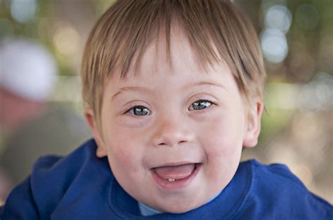 Down Syndrome Treatment And Management Atlanta Downs Syndrome Association