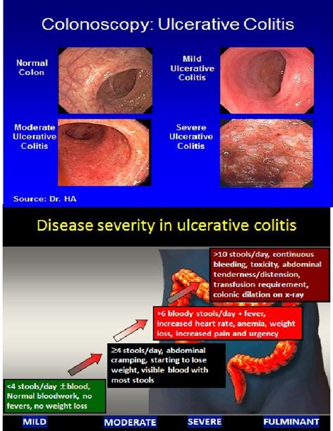 Ulcerative Colitis Ursache