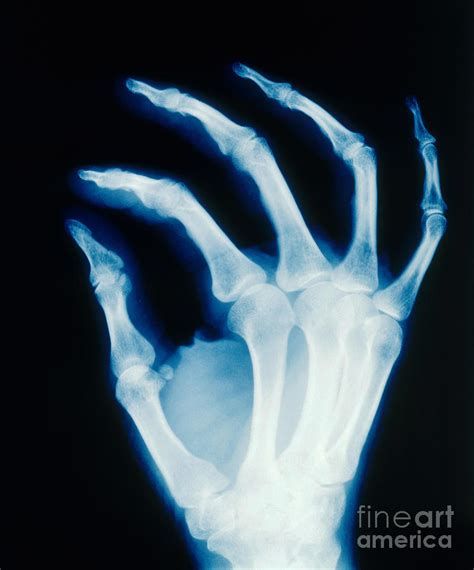 Hand X Ray Healthy Photograph By Erich Schrempp Fine Art America
