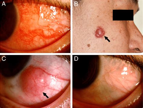 Clinical Appearance Of Rosai Dorfman Disease Rdd With Ocular And