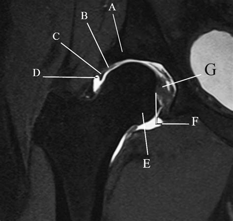 Coronal Magnetic Resonance Arthrogram Of The Hip The Bmj