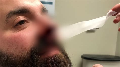 Louisiana Man Has Nose Reattached After It Was Bitten Off In A Bar Fight