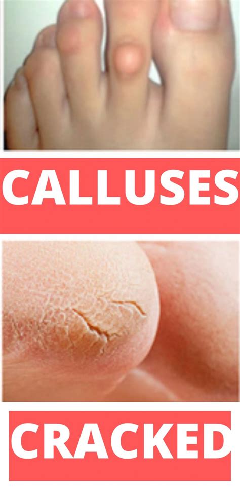 Pin On What Is The Best Way To Remove Warts