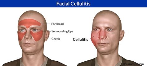 Cellulitis Of Face Treatment