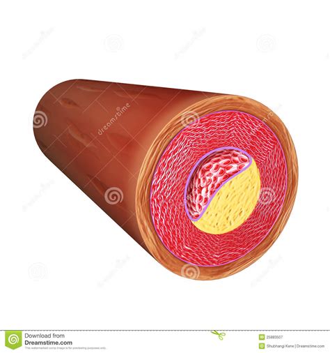 The diagrams may be plan or of a given section or cell. Artery Atherosclerotic Plaque Stock Illustration ...